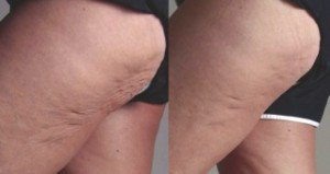 Before and After Resolution MD Treatment
