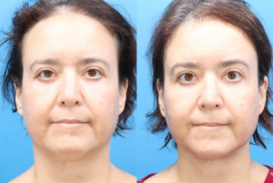 before and after blepharoplasty