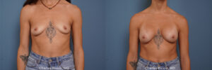 before and after breast augmentation